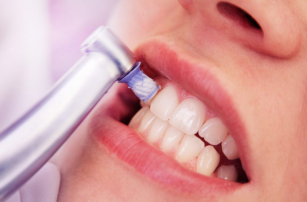 Close-up Professionelle Zahnreinigung / die Zähne einer Frau werden poliert