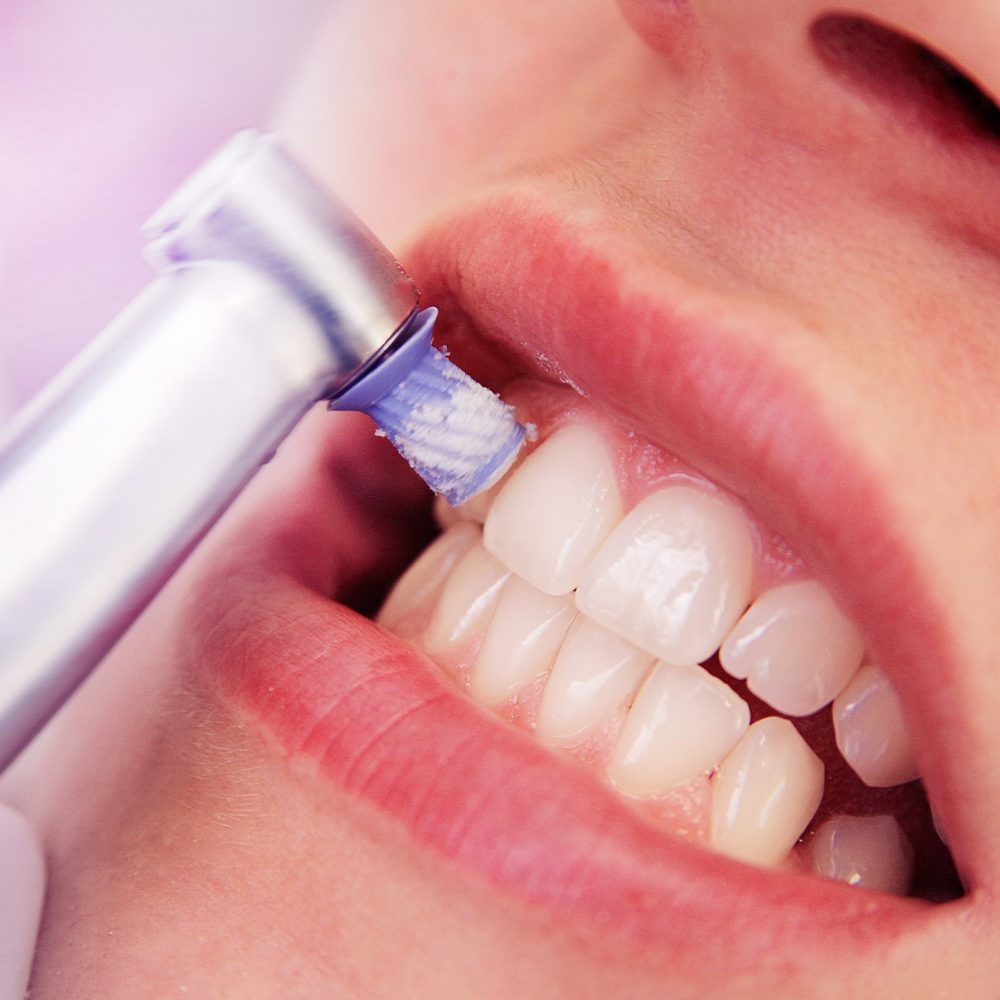 Close-up Professionelle Zahnreinigung / die Zähne einer Frau werden poliert