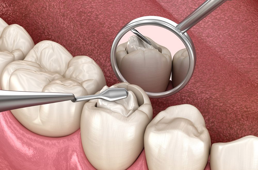 Decayed tooth restoration with composite filling. Medically accurate tooth 3D illustration.